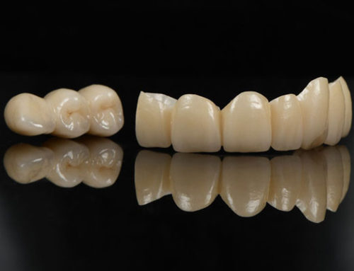 Different Types of Dental Crowns: What’s the Best Option for You?