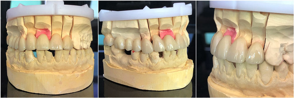 a finished zirconia case