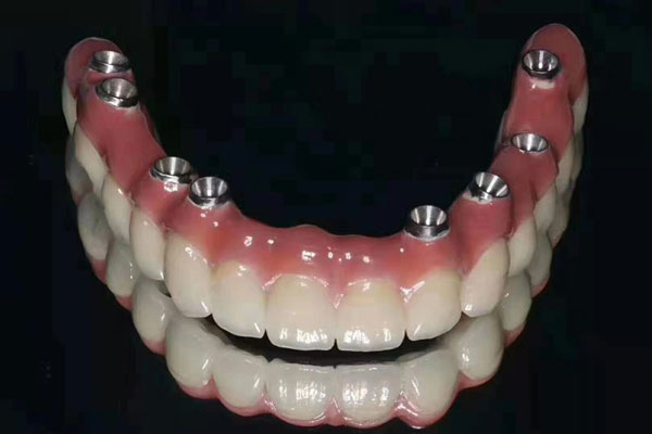 Dental-Implant-Case