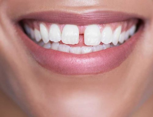 Gaps Between Teeth: What You Need to Know