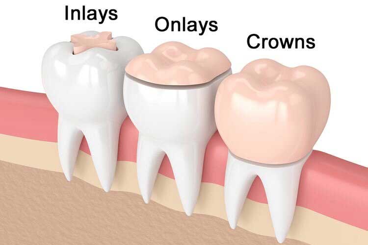 Inlays Onlays Crowns