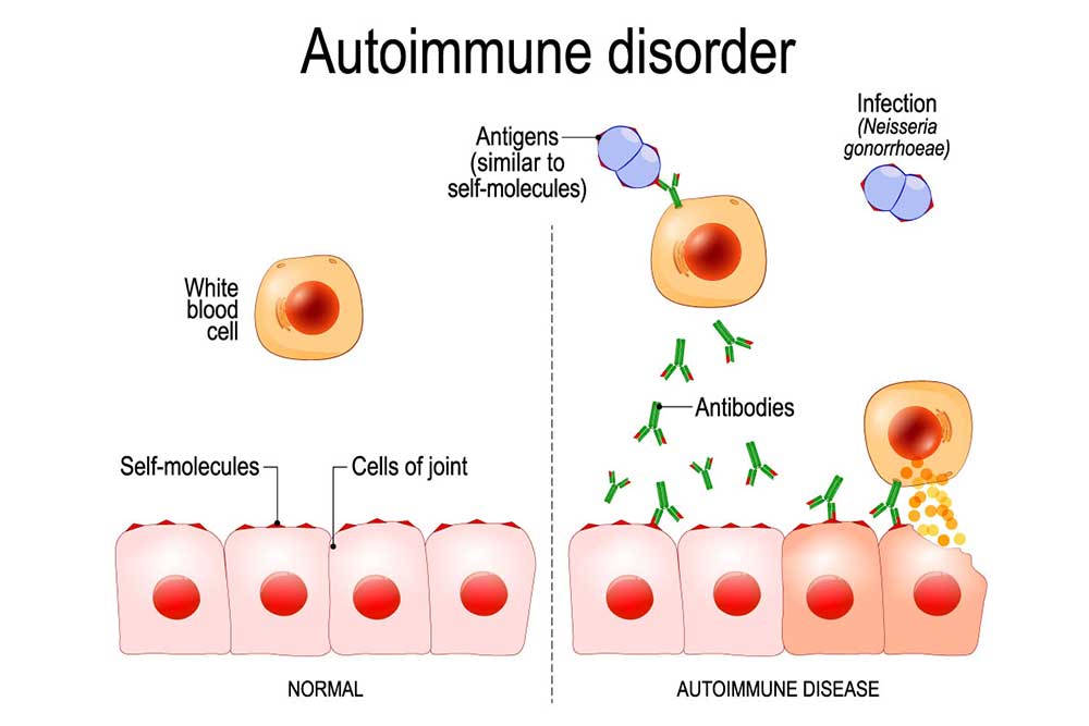 auto immune condition