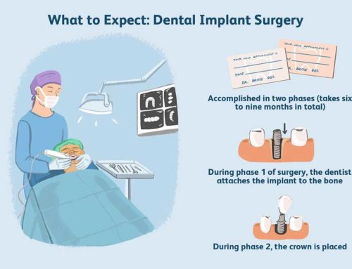 How to Prepare for a Dental Implant Procedure?