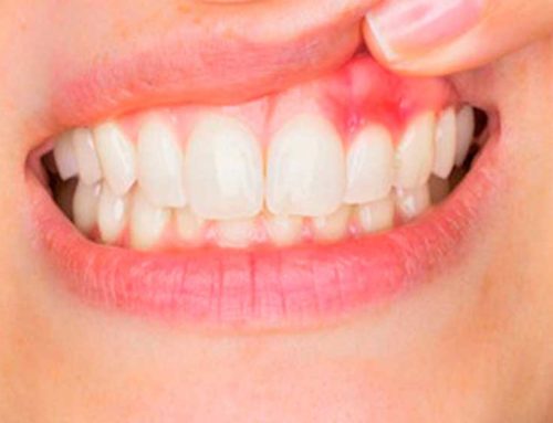 How to Treat Gum Disease?