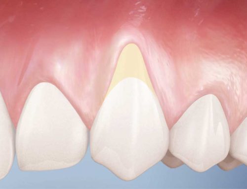 How to Deal with Teeth Exposed Roots?