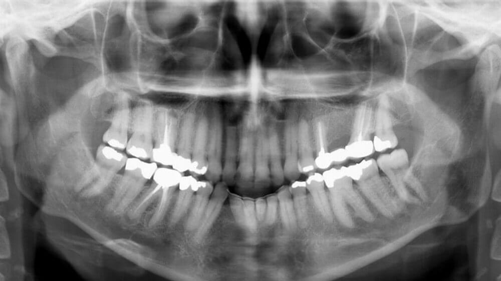 X-ray for aligner treatment