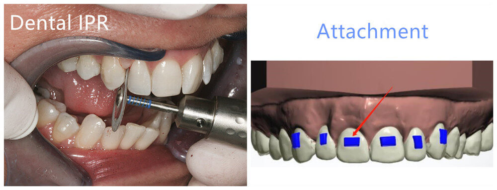Dental IPR and Attachments