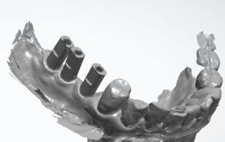 Digital dental implant case