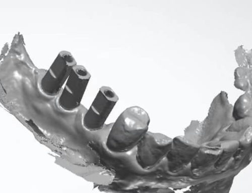 Implant libraries and digital analogs for digital dental implant cases