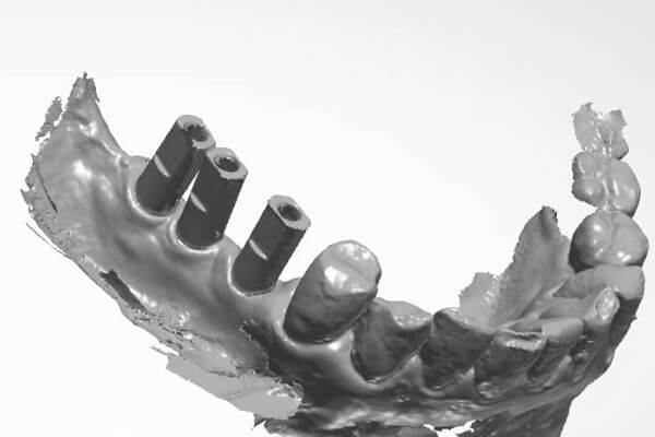 Digital dental implant case