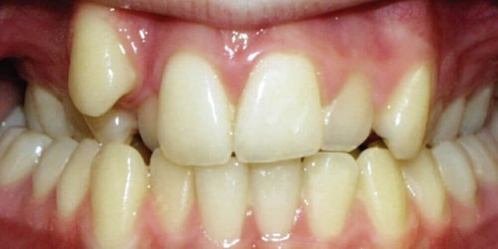 Severely-crooked-teeth