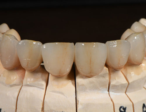 Shade and Anatomy of dental cases