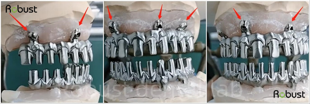 Solutions for difficult implant dental cases