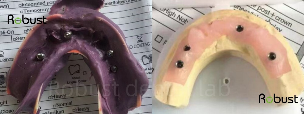 dental impressions with 4 implants