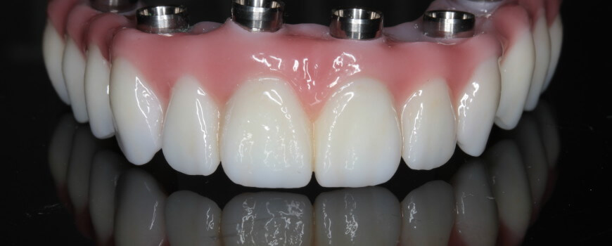 Robust Dental Implants