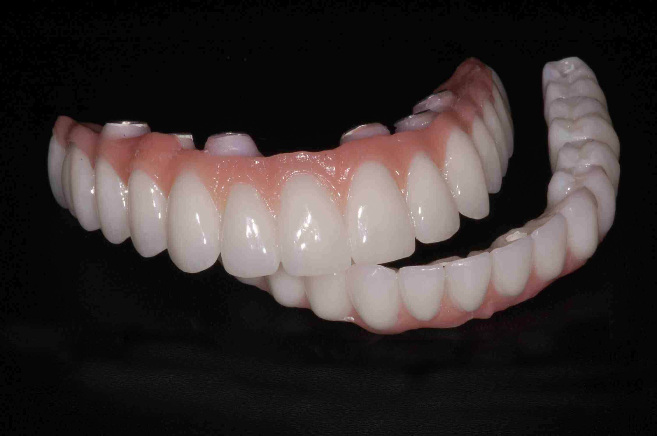 Robust Dental Implants