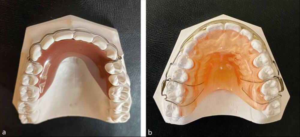 Robust Dental Retainers