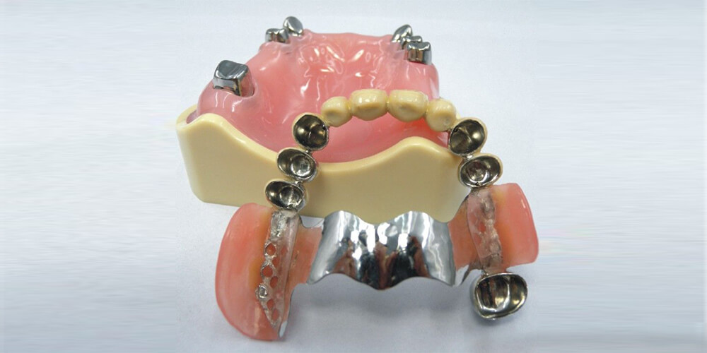 Robust Telescopic Crowns