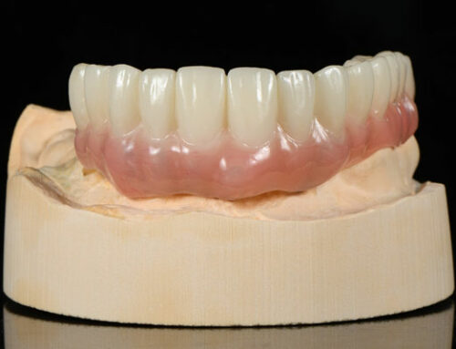 Why are temporary bridges necessary for big dental cases?