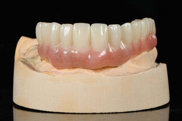 Temporary-Teeth