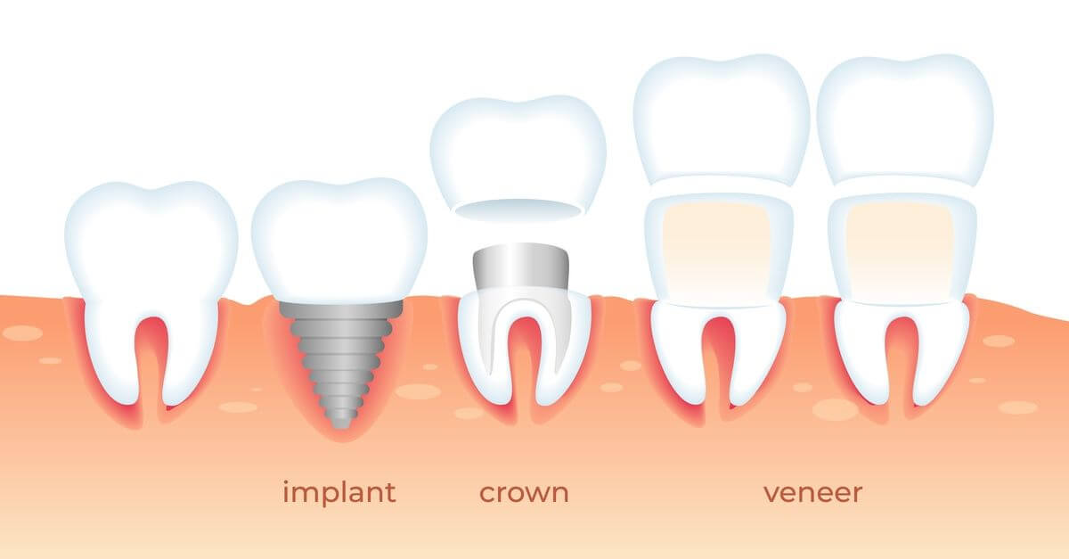 crowns or implants-02