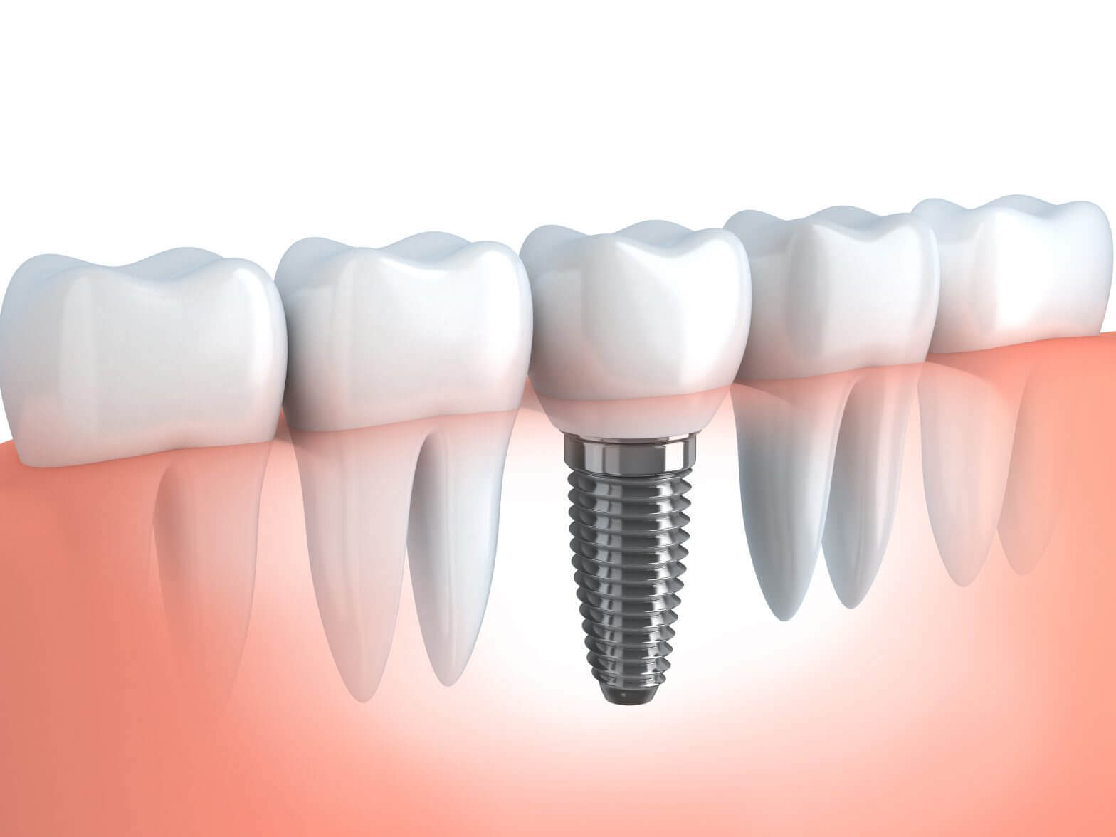 Dental Implant-01