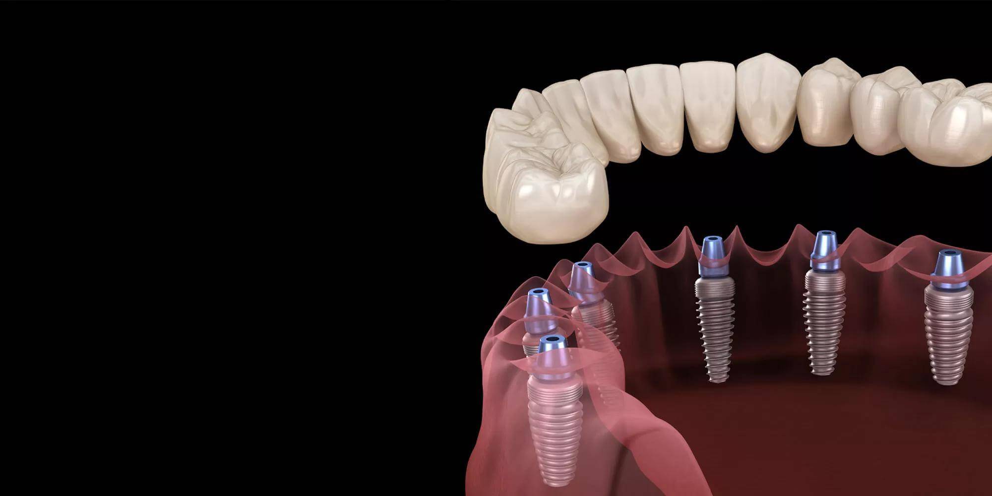 Dental Implant-03