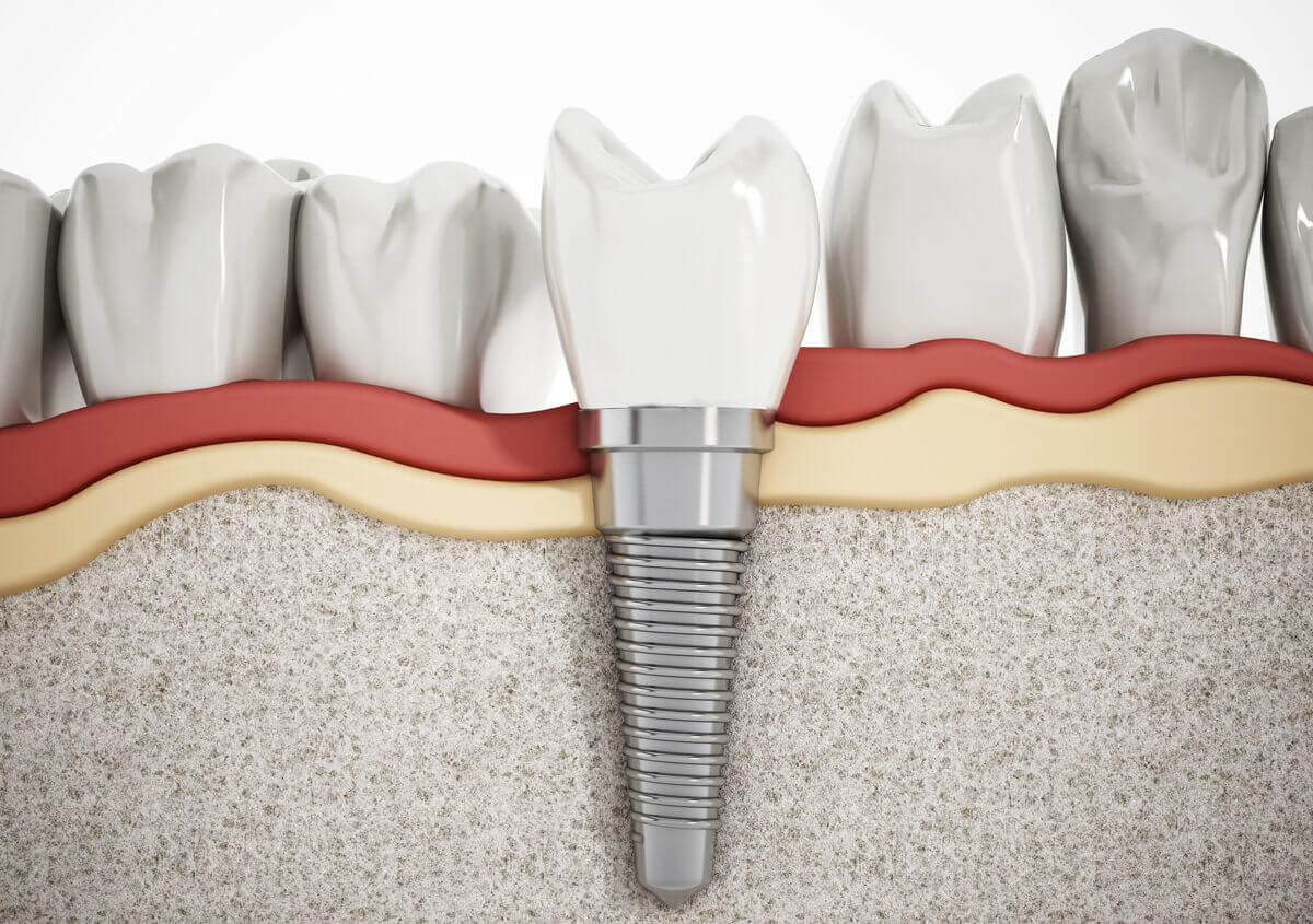 Dental Implant-05