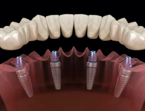 The Complete Guide to Dental Implant Types.
