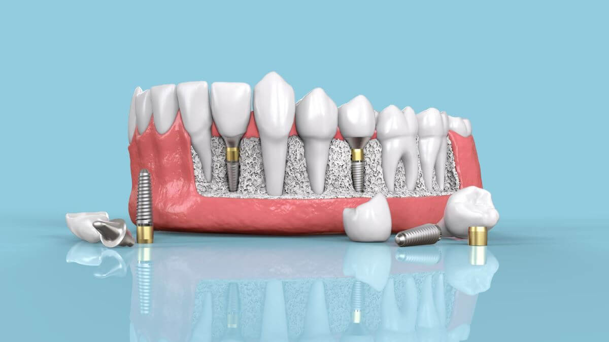 Dental Implant Types-02