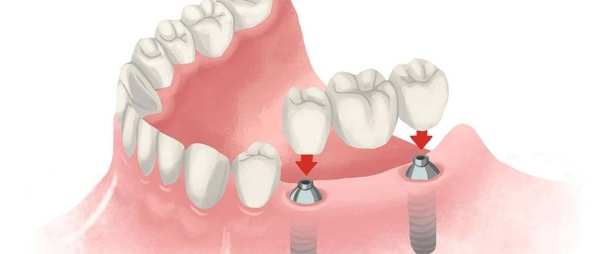 Dental Implant Types-03