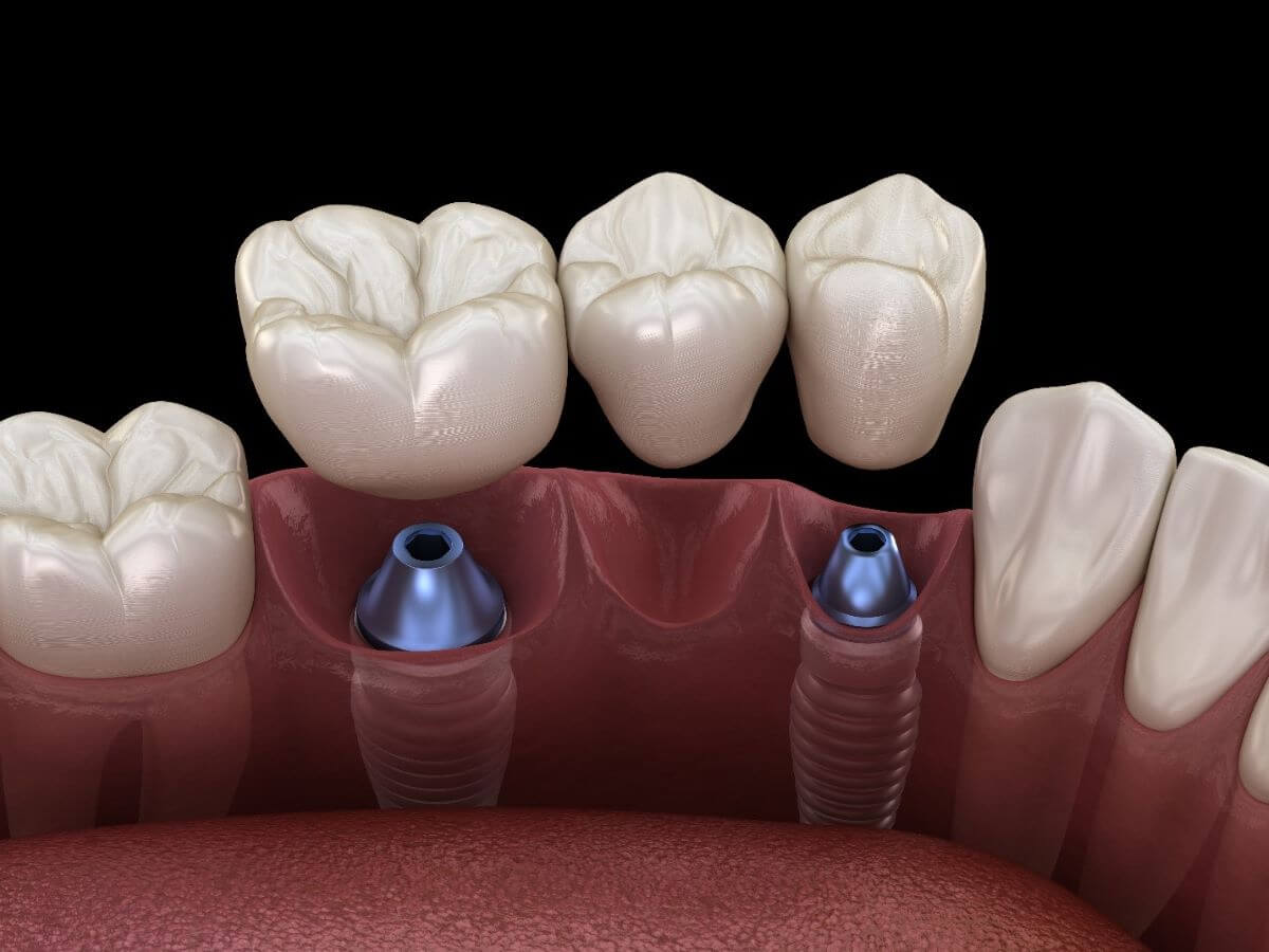 Dental Implant Types-04