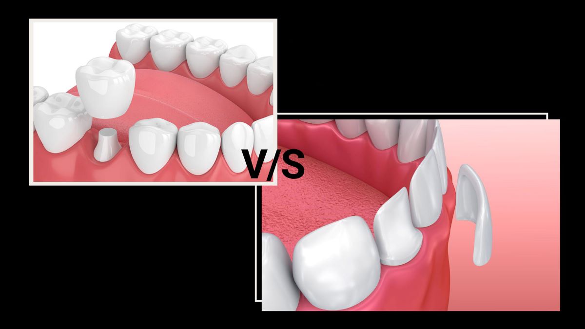 Dentures vs. Veneers-02
