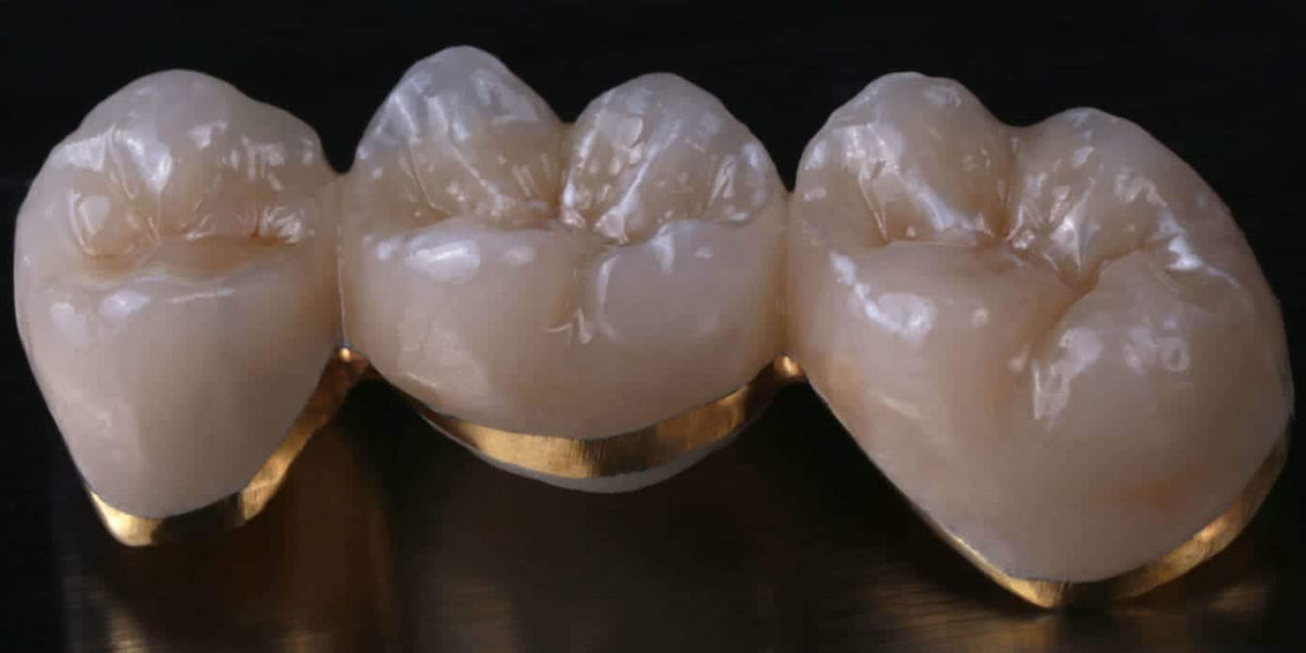 types of dental crowns-02