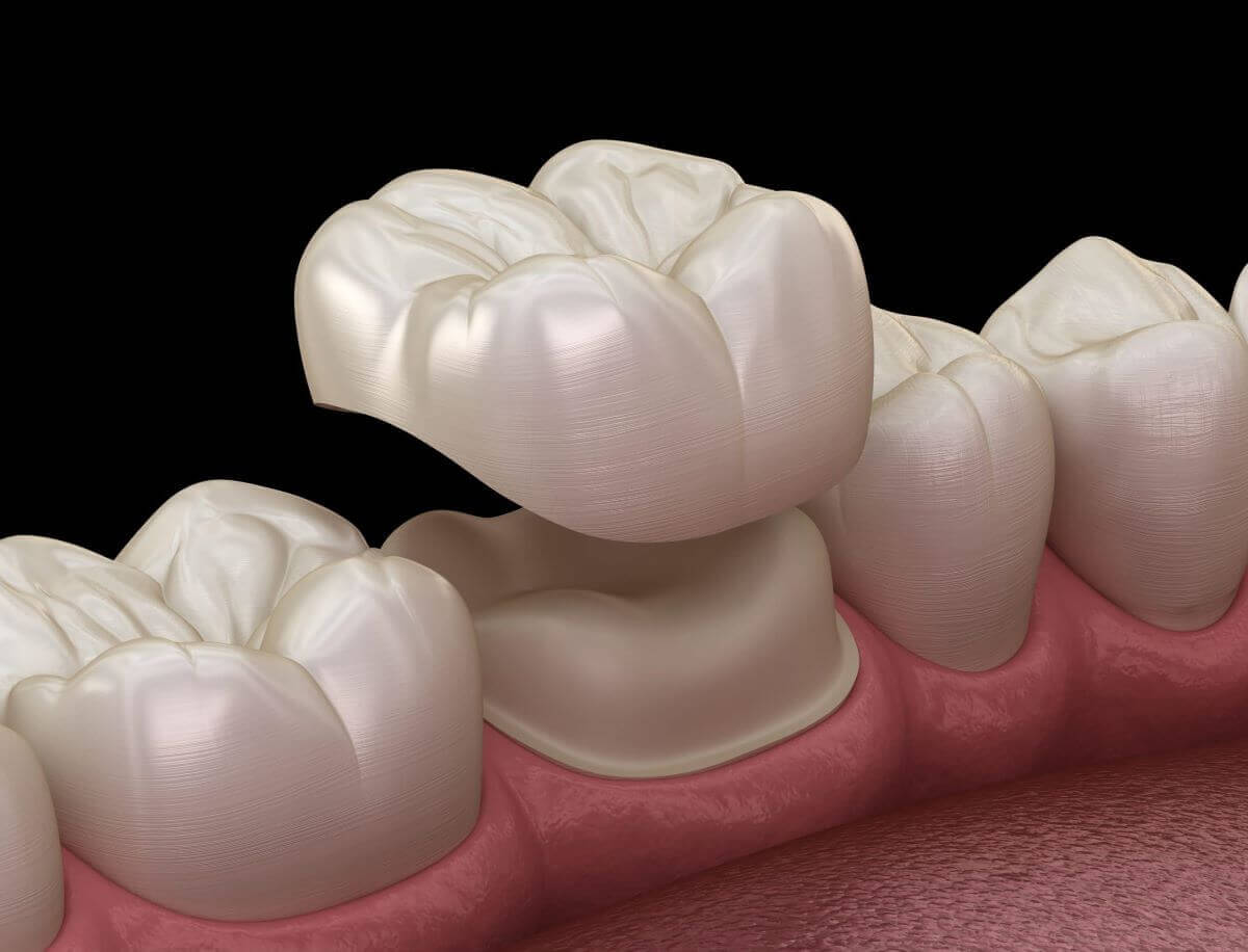 The Complete Simple Guide to Dental Crowns!-01