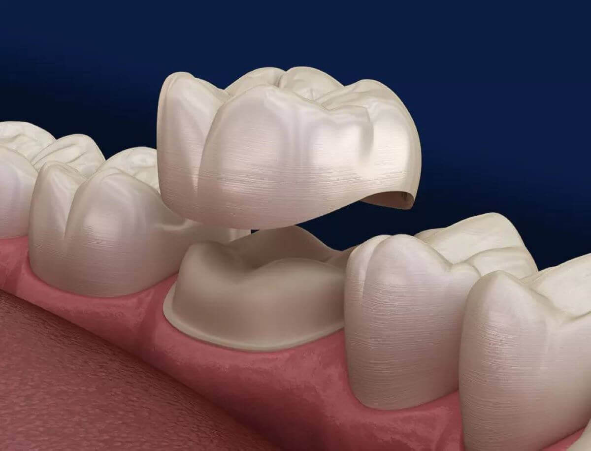 The Complete Simple Guide to Dental Crowns!-02