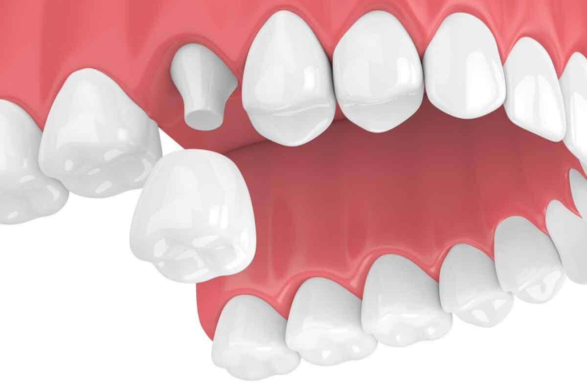 The Complete Simple Guide to Dental Crowns!-03