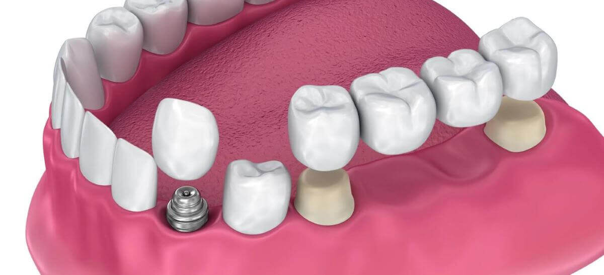 The Complete Simple Guide to Dental Crowns!-04