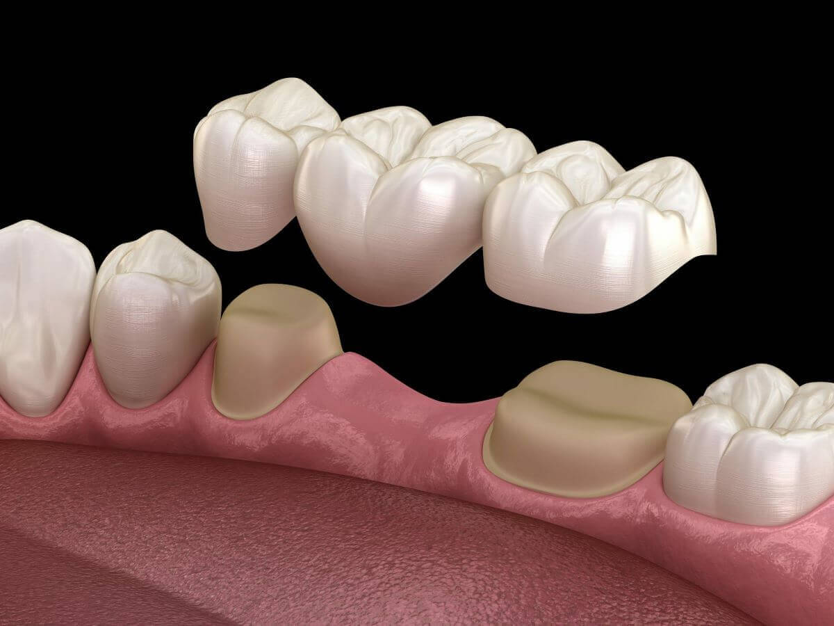 The Complete Simple Guide to Dental Crowns!-05