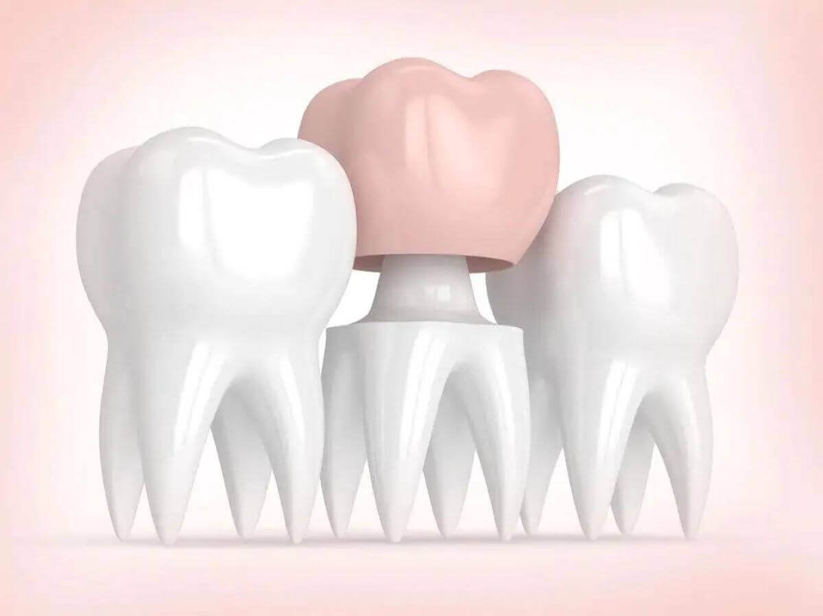 The Complete Simple Guide to Dental Crowns!-06