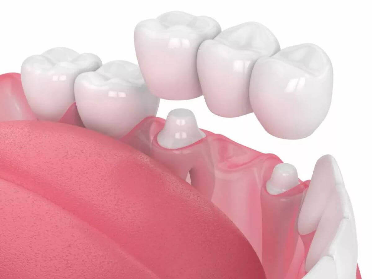The Complete Simple Guide to Dental Crowns!-08