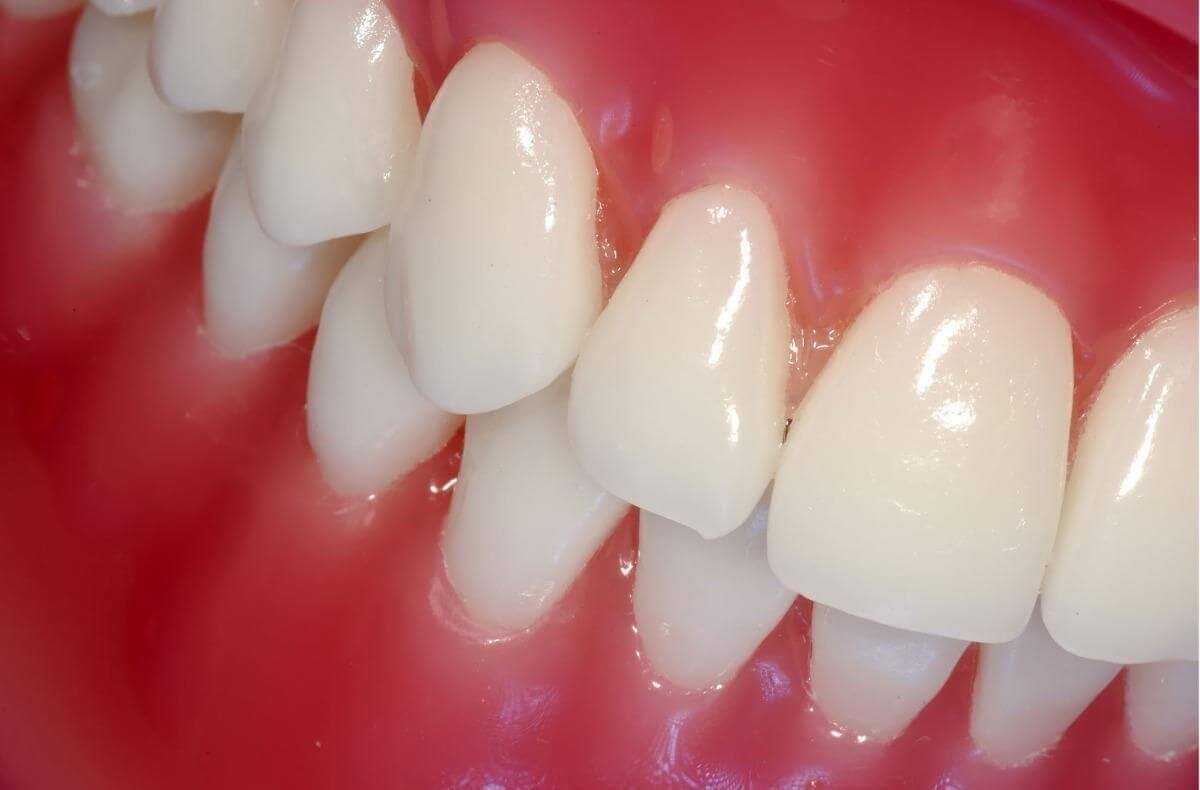 The Complete Simple Guide to Dental Crowns!-09