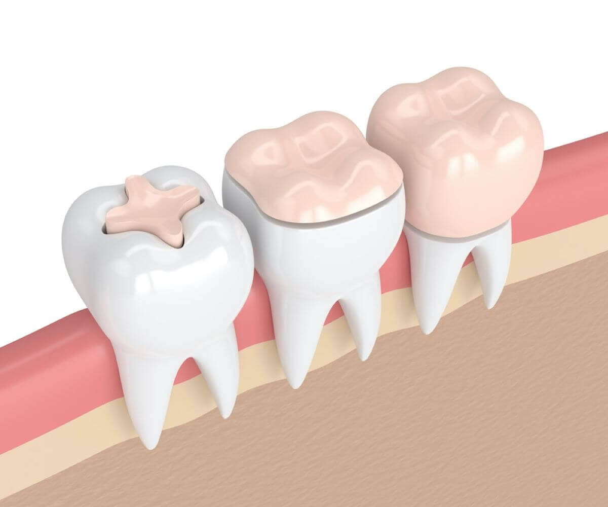 The Complete Simple Guide to Dental Crowns!-10