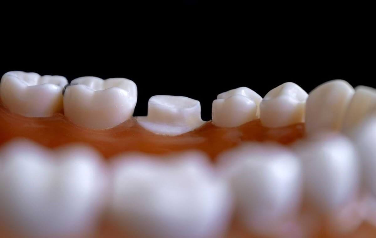The Complete Simple Guide to Dental Crowns!-11