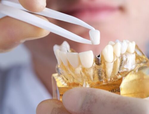 What to do after dental implants: The Guide are Tips and Tricks