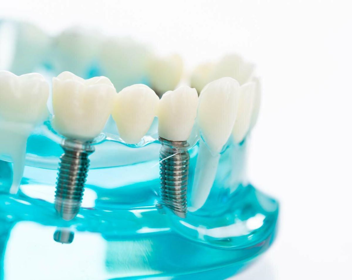 Dental implants care-02