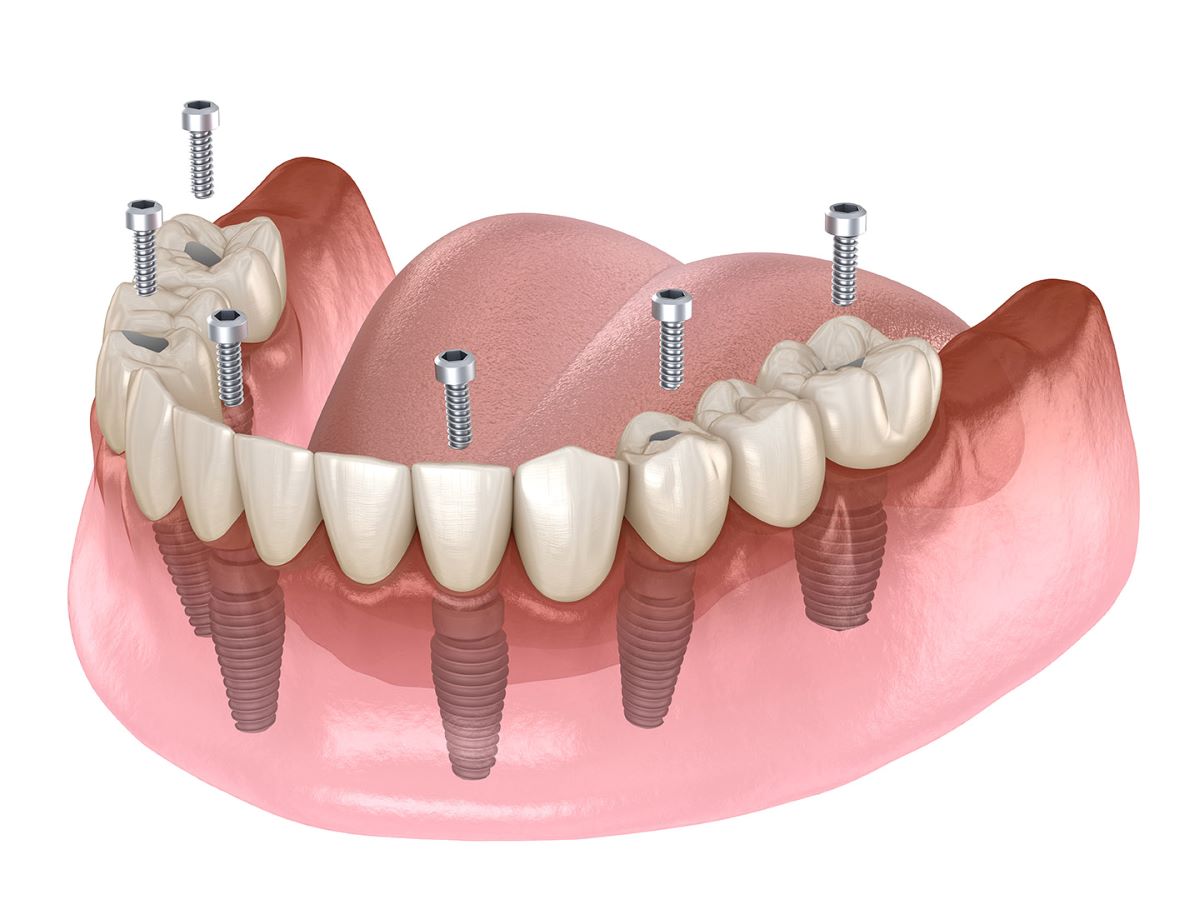 Dental implants care-03