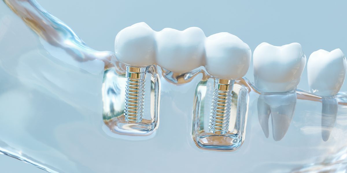 Dental implants care-04