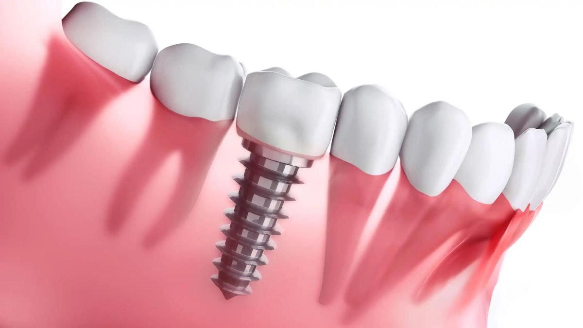 Dental Implant-04