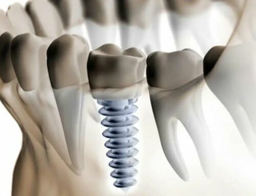Dental Implant: Everything You Need To Know